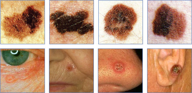 cancer-photos-new